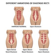 diastasis recti abdominal separation