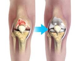 complex total knee replacement boston