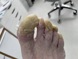 fungal nails mcr feet