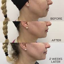 non surgical face lift before and after