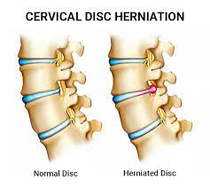 cervical disc herniation doctors nj nyc