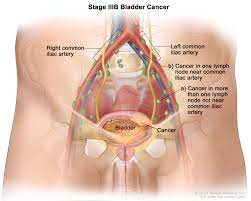 Learn more about this stage, where it spreads, treatment options and questions to ask your doctor. Bladder Cancer Treatment Bladder Cancer Pictures Signs Symptoms To Better Understand Diagnosis Cleveland Oh University Hospitals