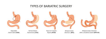 bariatric surgery vs weight loss s