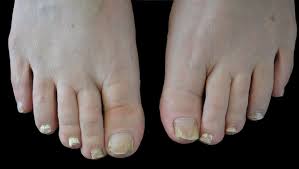 fungal nail infection diagnosis and