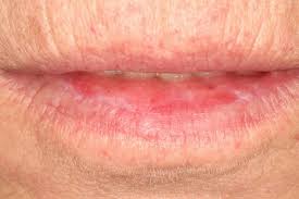 red lesions of the mucosa