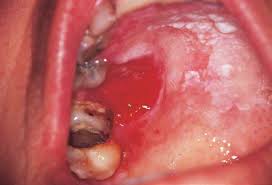 Image result for red spotted in human mouth