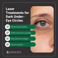 laser treatment for dark under eye