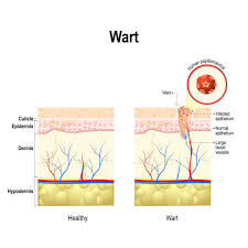 female warts