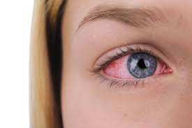 seasonal allergies affect your eyes