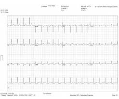 Racgp Cardiac Stress Testing Stress Electrocardiography