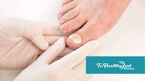 foot doctor treat toenail fungus
