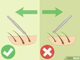 Zapping off hair with a laser used to be a niche procedure, but it's now gone mainstream. 3 Ways To Avoid Bumps When Plucking Hair Wikihow