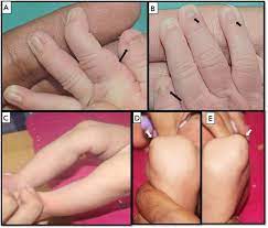 diagnosing nail patella syndrome can
