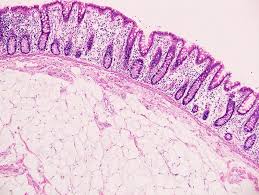 lipomatosis of the ileocecal valve