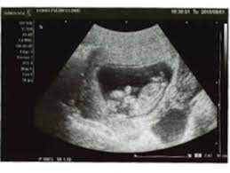 妊娠12週目エコー写真と胎児の大きさ・流産の壁の実際 [妊娠初期] All About