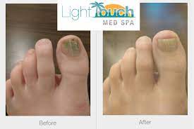 laser toenail fungus treatment