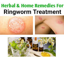 herbal remes for ringworm treatment