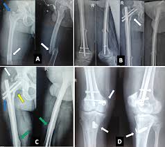 concomitant fractures of proximal femur