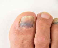 preventing and treating black toenails