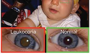 app can detect white eye in children