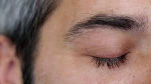 squamous blepharitis inflamed eyelids