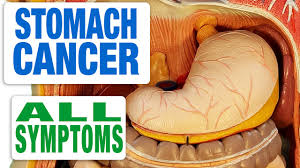 Because advanced stage stomach cancer has grown and spread, it can also effect nearby organs including: Stomach Cancer All Symptoms Youtube