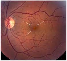 cystoid macular edema retina vitreous