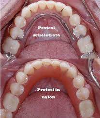 Forma superficiale del rivestimento resina, lucidatura del corpo protesico. Protesi Flessibili In Nylon Senza Palato E Ganci Metallici Dentista Resta