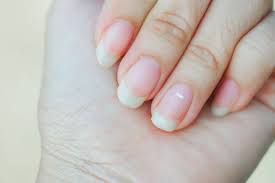 white spots on nails causes and treatment