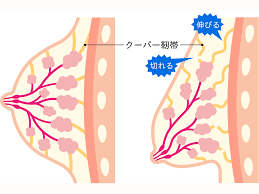 クーパー靱帯は切れるとどうなる？原因と対処法を紹介│ナイトブラ研究室