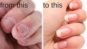how to stop biting your nails break