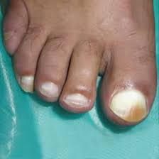 nails and liver disease