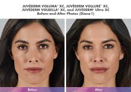 But their results expire and they can't tighten the skin or reposition the deep tissues, says plastic. Blue Medcenter Dermal Fillers And Volumizers