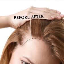 prp hair loss therapy the grand