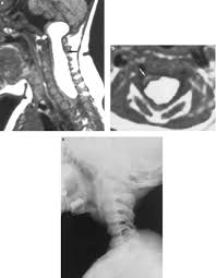 spinal intramedullary lipoma report of