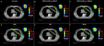 stereotactic radiation therapy
