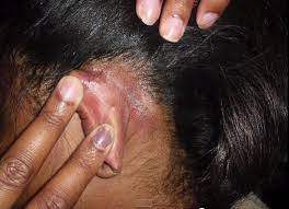the harmful effects of relaxers a