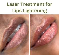 laser treatment for lips lightening