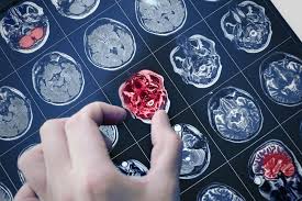 Aducanumab is a recombinant human monoclonal antibody (mab) that binds primarily to aggregated forms of aβ fda likely to approve biogen's aducanumab for alzheimer's disease after its review. Alzheimer S Disease Biogen Unveils Results From Studies For Aducanumab