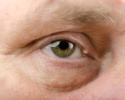 what is a fat cyst in the eye