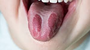 geographic tongue symptoms causes