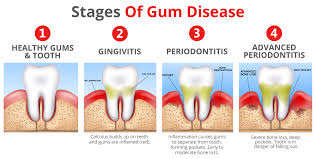learn about gum disease gum infection