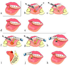 treatment of the lips using a co2 laser