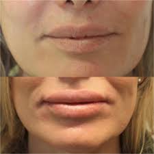 lip augmentation dr glancey clinics