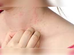 skin redness rashes information in