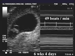 First Trimester Pregnancy Loss Heart Rate