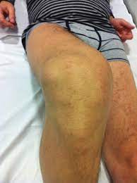 swelling and cyst formation at the