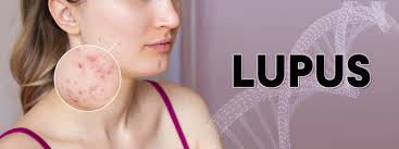 lupus symptoms and treatment