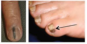 12 nail changes a dermatologist should