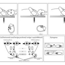 horizontal c bppv cupulolithiasis